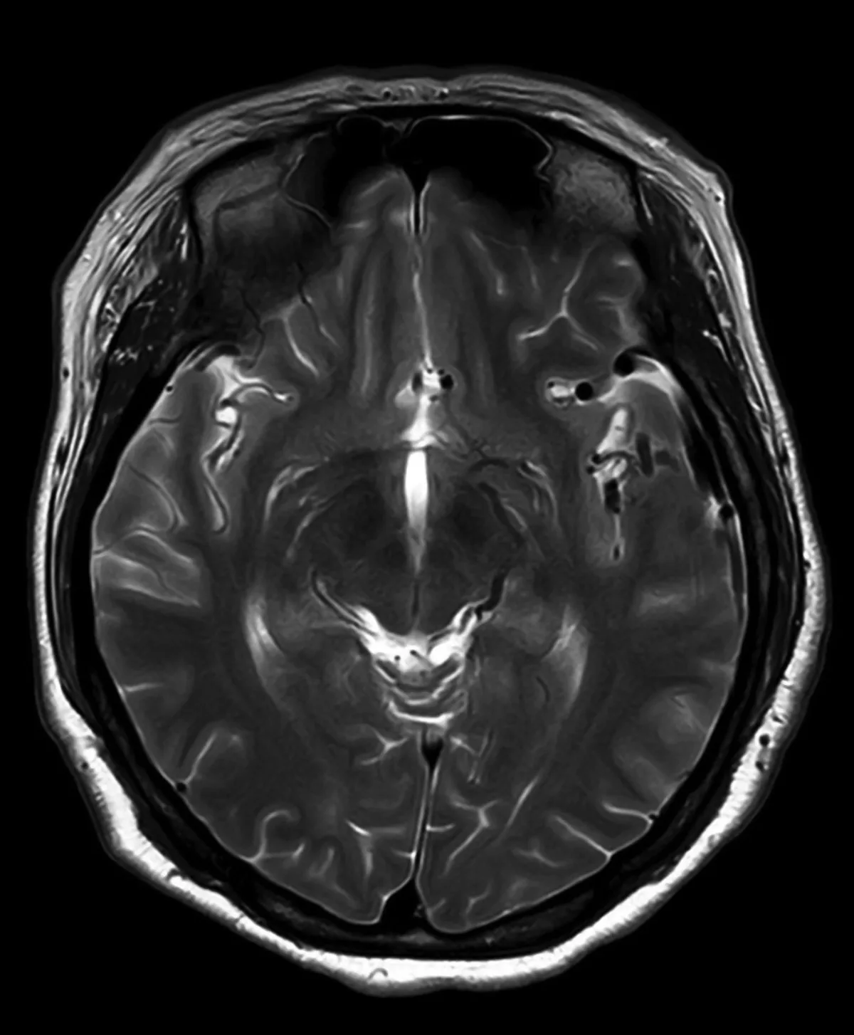 Accelerated Symptom Reduction in Severe OCD with Anodal tDCS + CET
